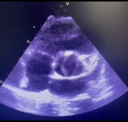 Cardiopatia