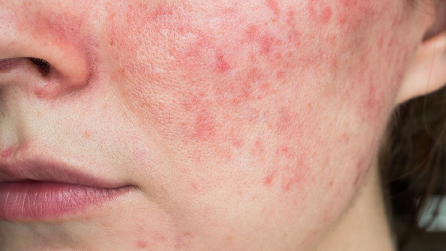 rosacea-causas-tratamientos