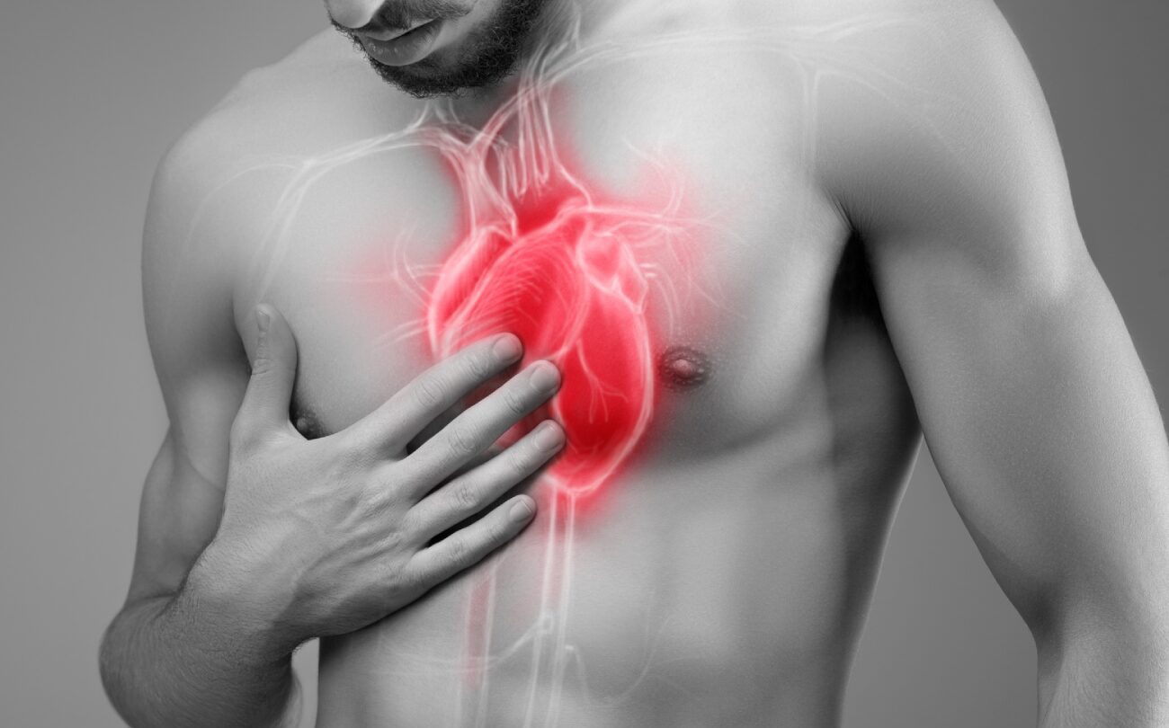 infarto de miocardio
