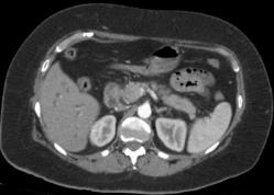 Hepatobiliopancreática 1