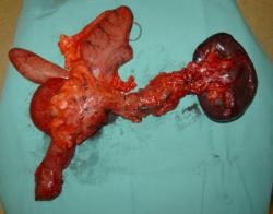 Hepatobiliopancreática 2